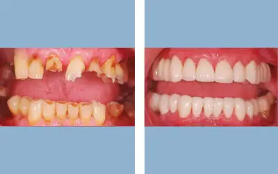 Before and After